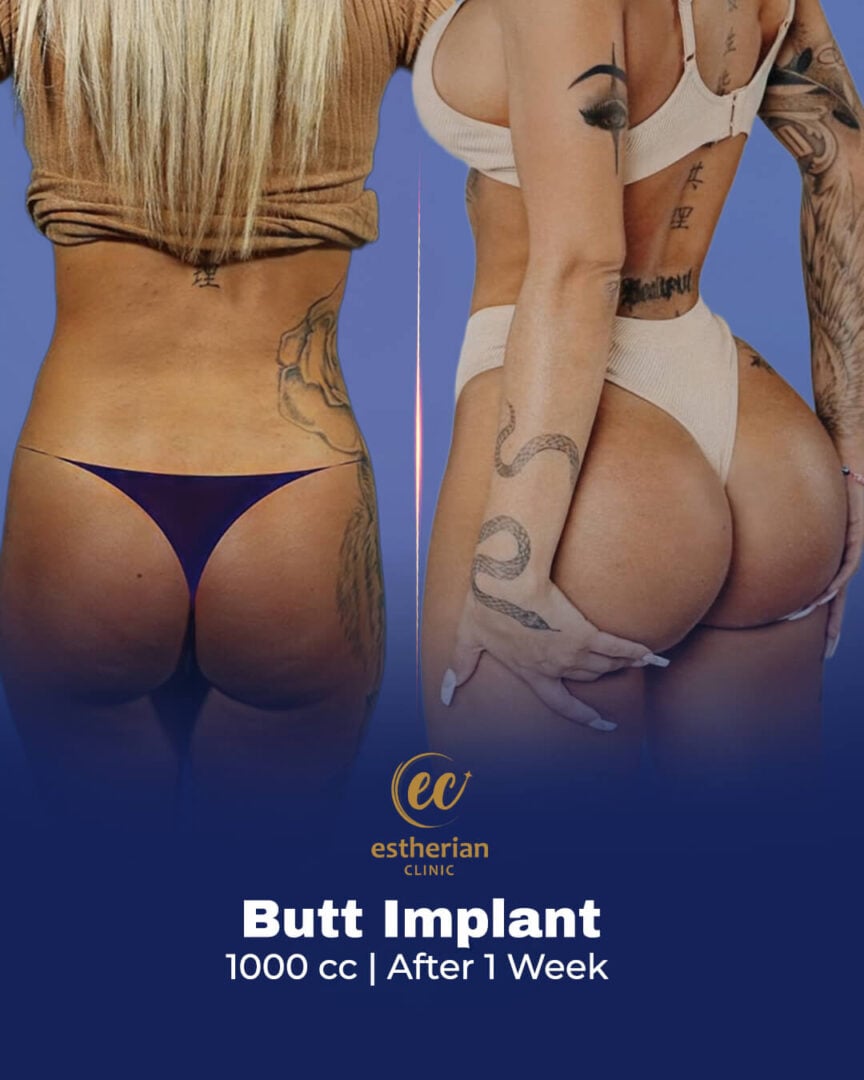 Résultats d'implants fessiers de 1000 cc