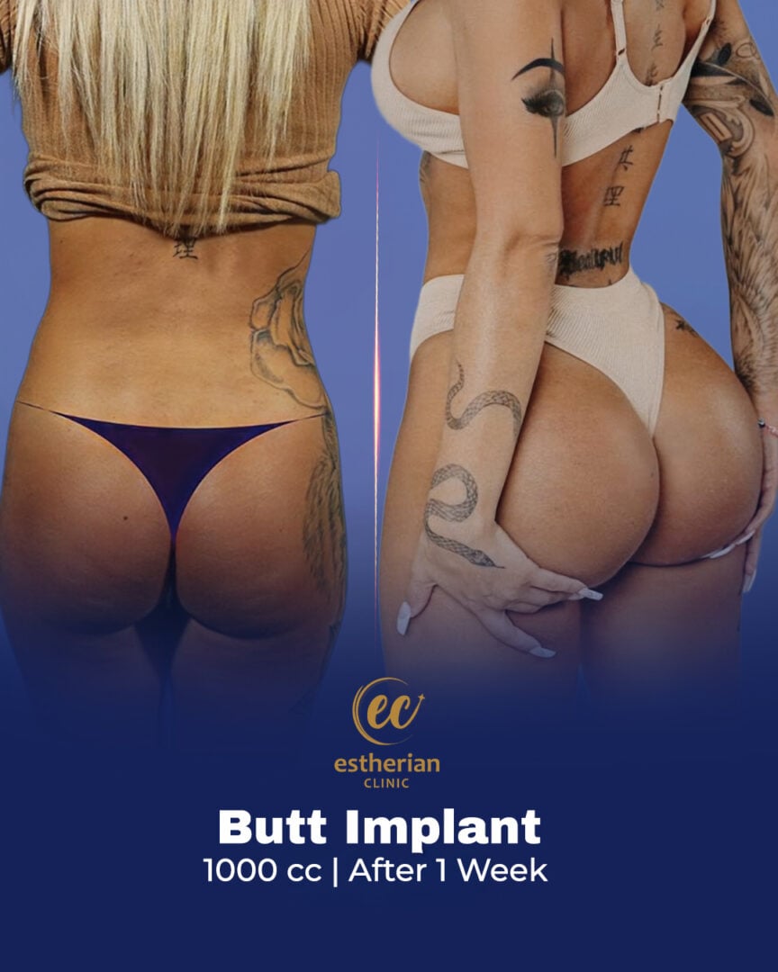 1000cc vorher und nachher (Ergebnisse)