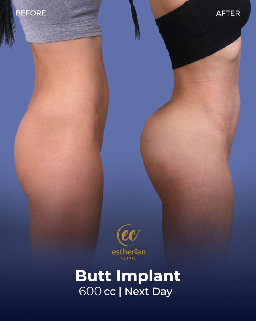 600-ccm-Po-Implantate: Vorher-Nachher-Ergebnisse