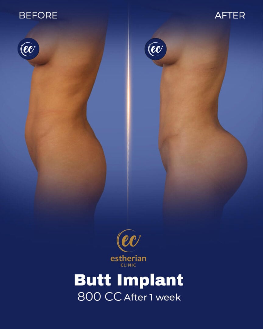 Implants fessiers de 800 cc