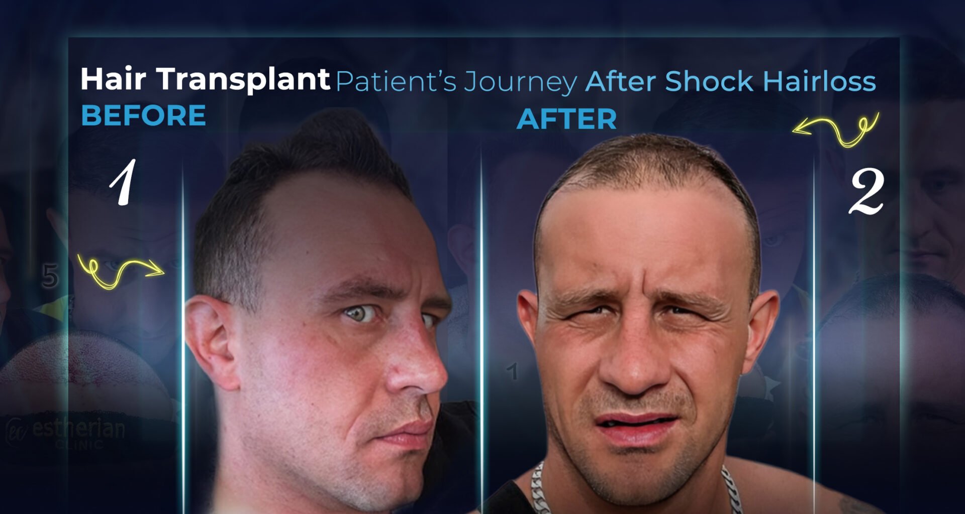 Nach schockierendem Haarausfall