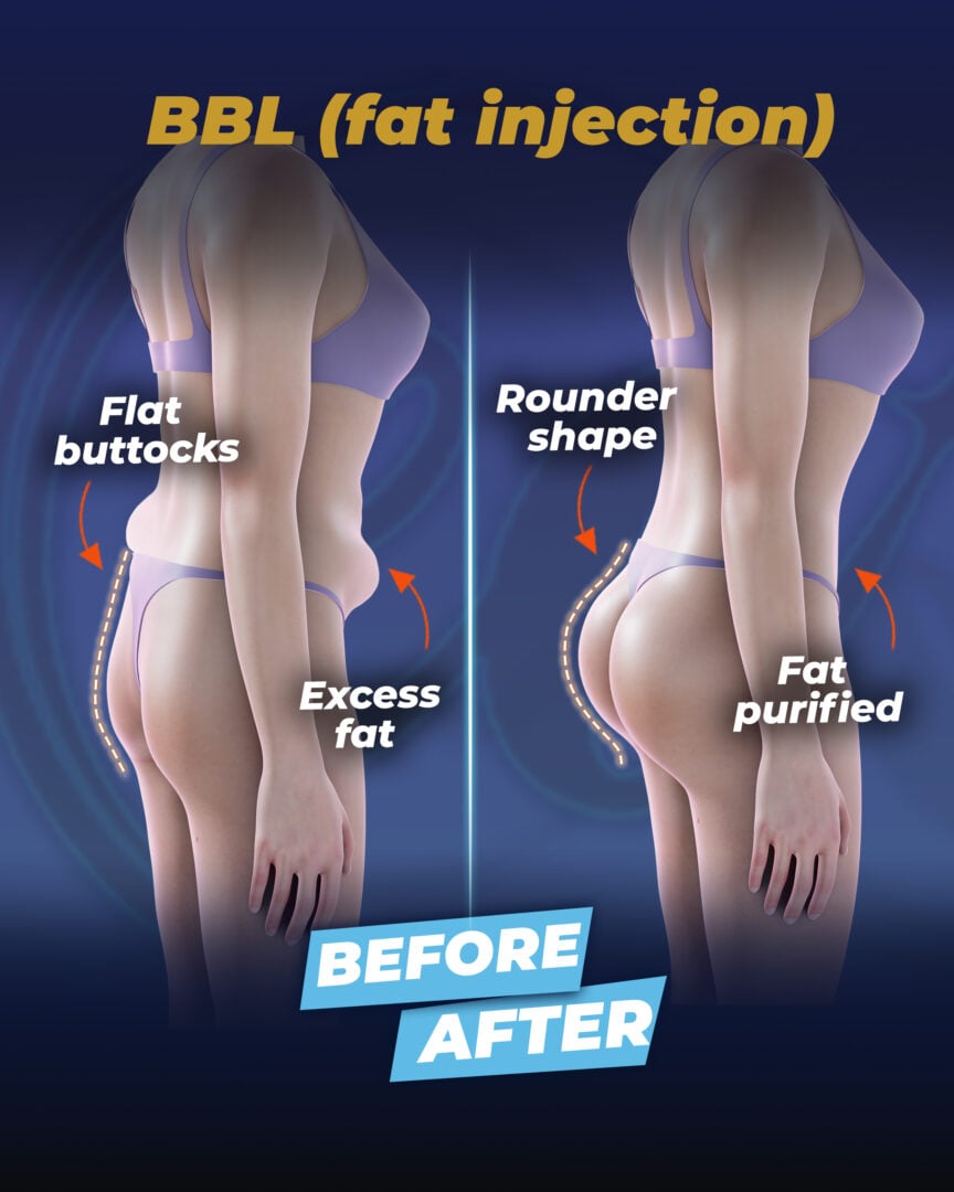 BBL with fat injection