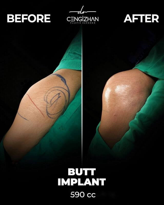 Gesäßimplantat (590 cm³) vorher und nachher