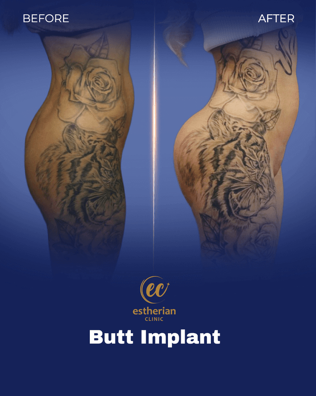 Résultats d'implants fessiers (photos avant et après) Clinique Estherian