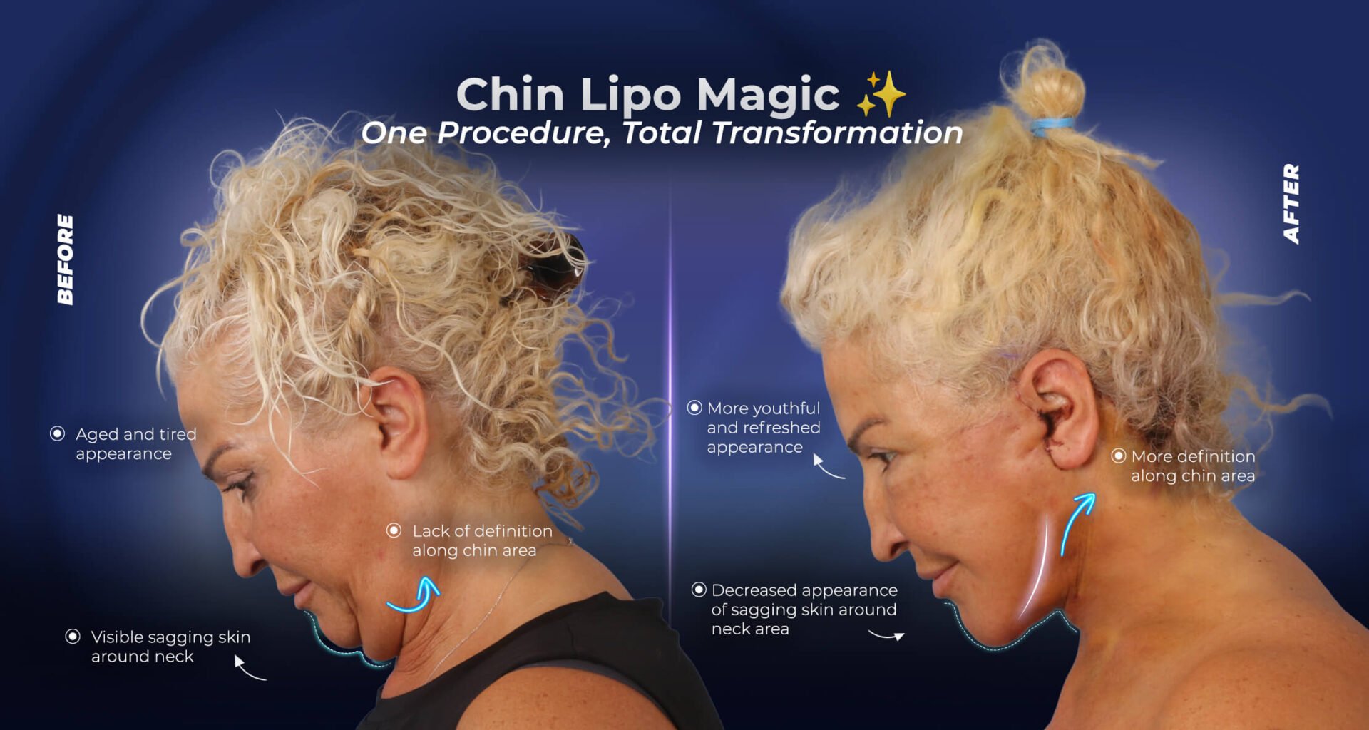 شفط دهون الذقن قبل وبعد