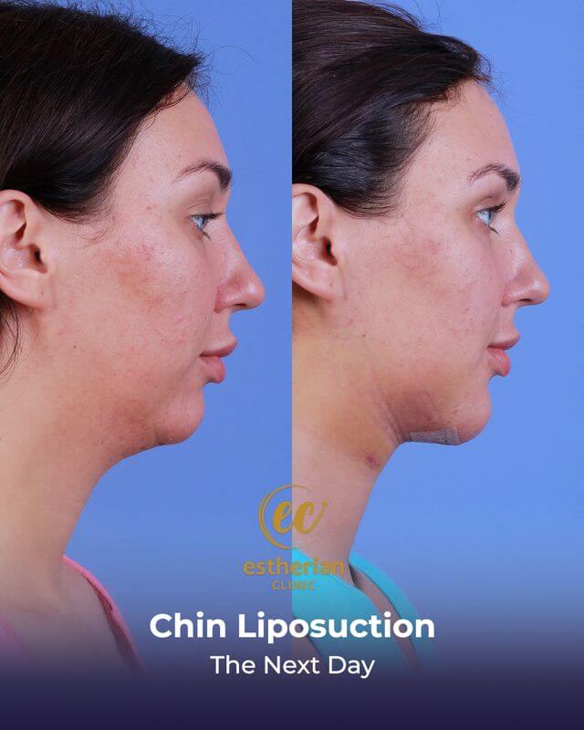 نتائج شفط دهون الذقن (في اليوم التالي) قبل وبعد