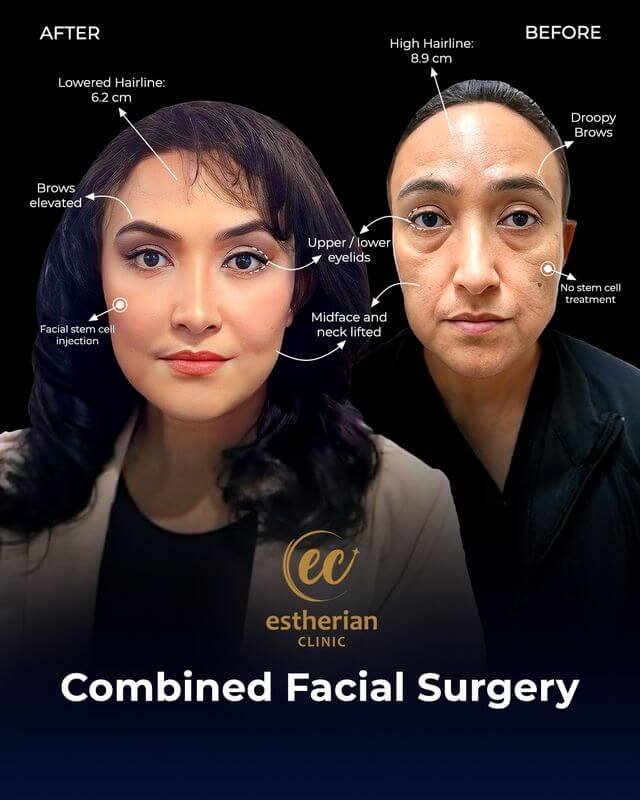Combined facial surgery (mid and neck face lift)