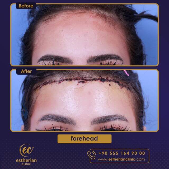 Alın Küçültme Ameliyatı Sonrası İyileşme ve Sonuçları