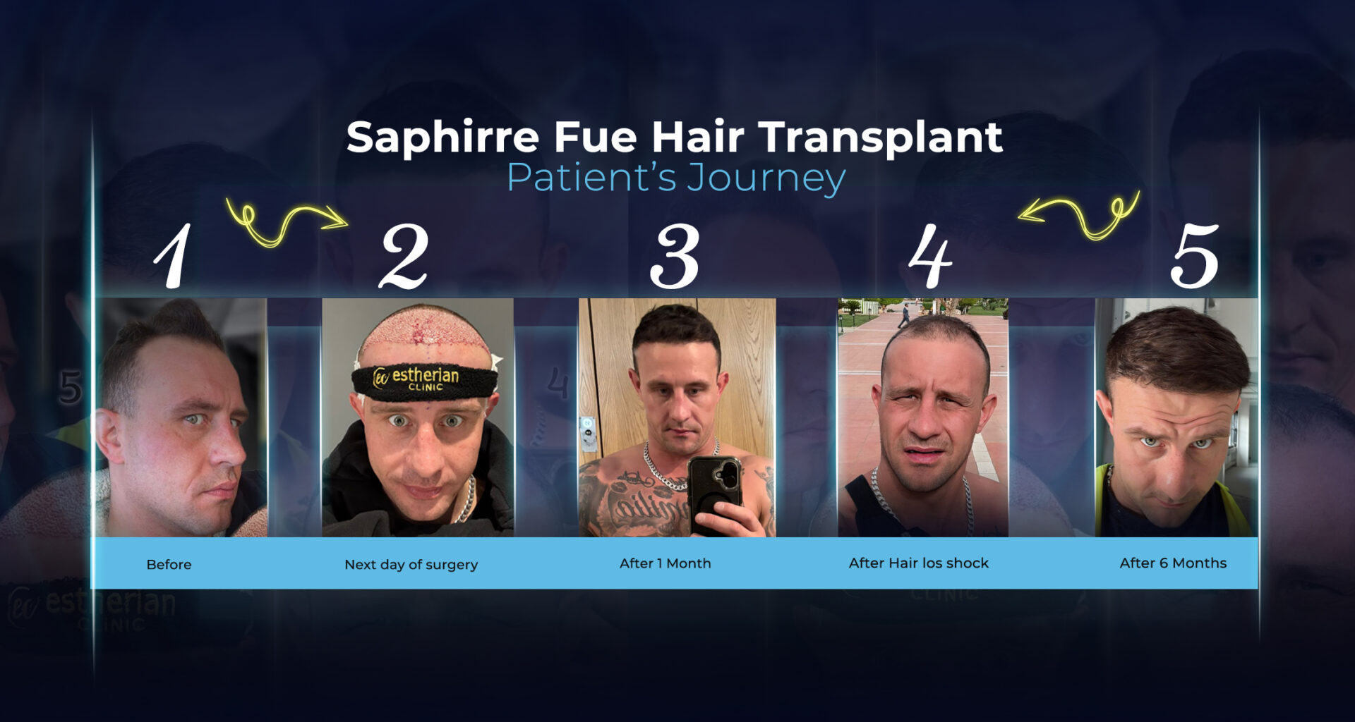 Vollständiger Zeitplan der Haartransplantation