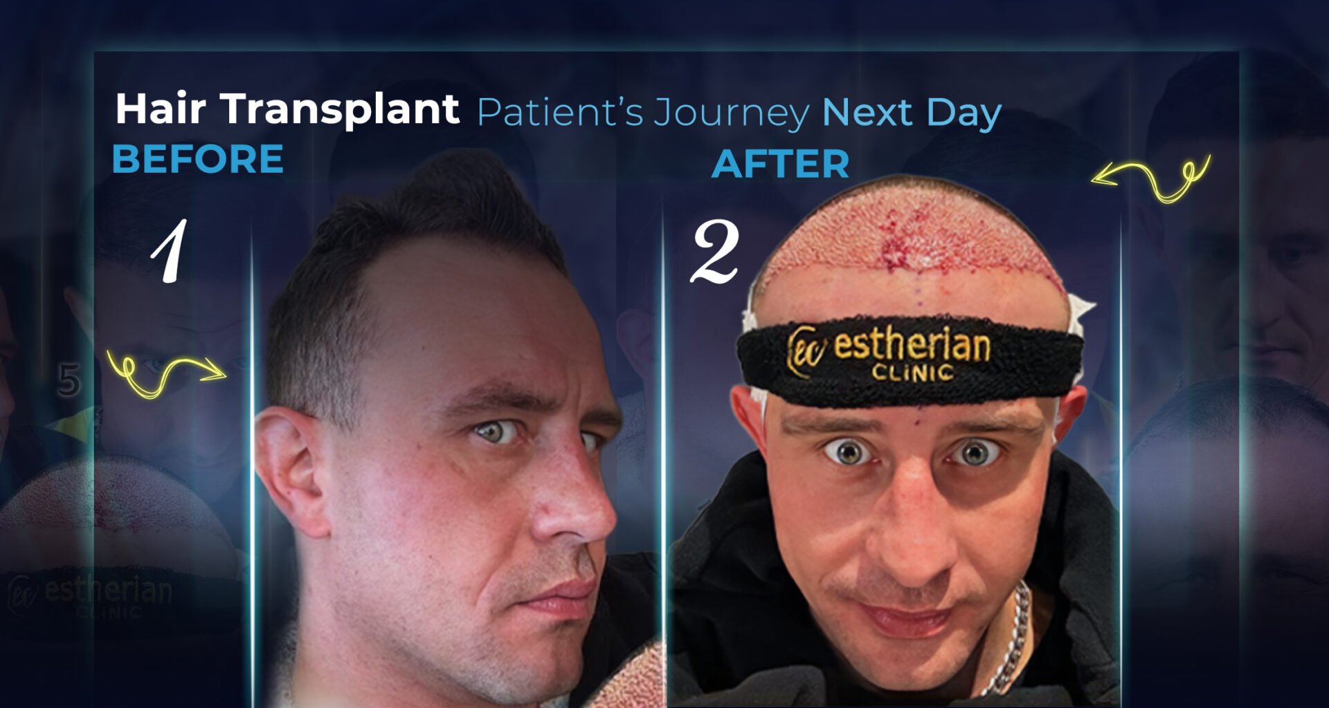Unmittelbar am Tag nach der Haartransplantation