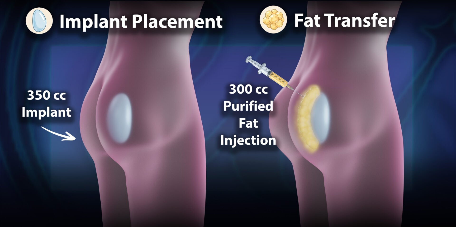 Fat Transfer Supported Butt Implant