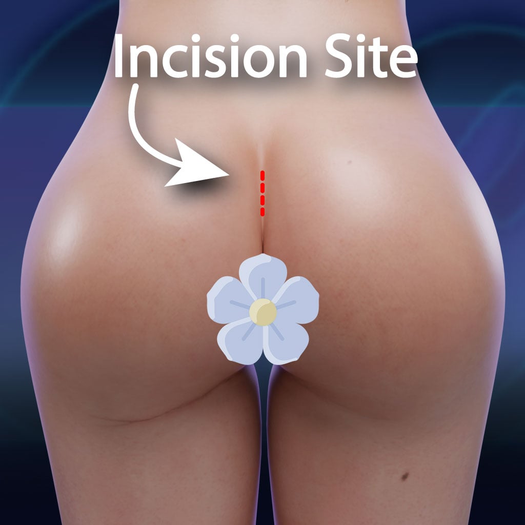 Incision Site of Butt Implant