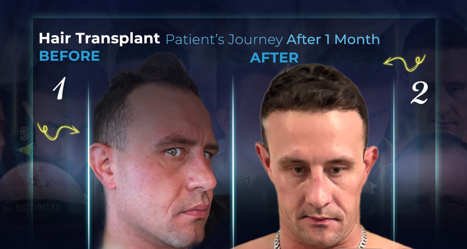 Ergebnisse nach einem Monat nach der Transplantation