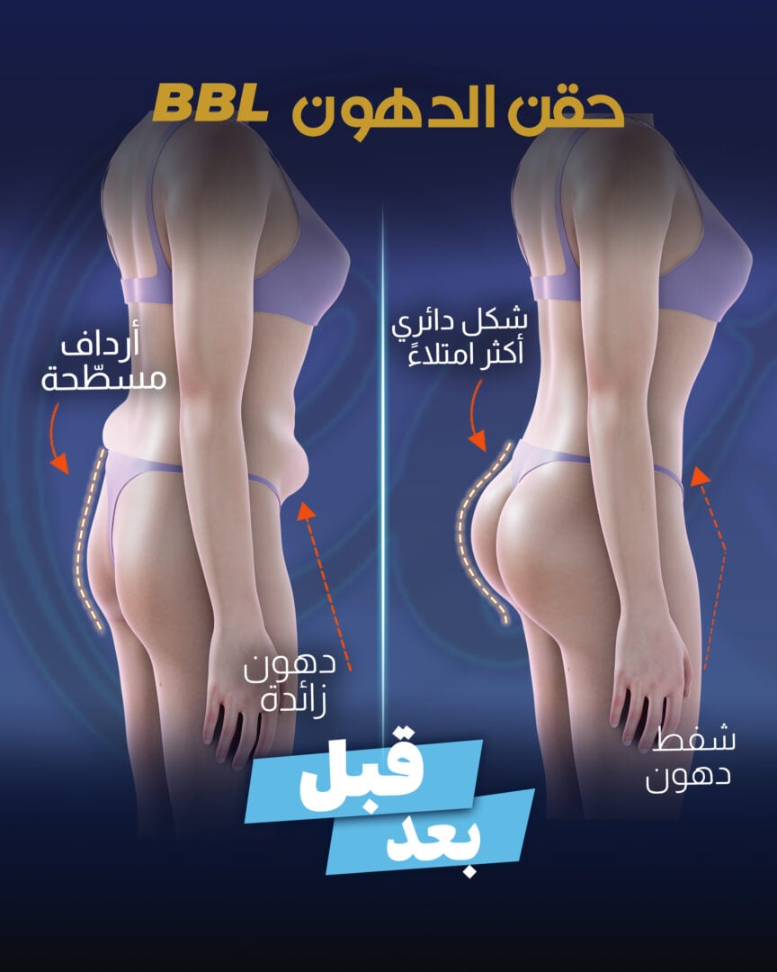 تكبير المؤخرة البرازيلية بحقن الدهون