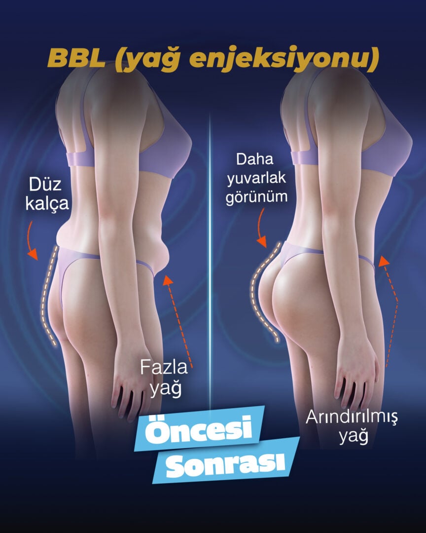 Yağ enjeksiyonu ile BBL