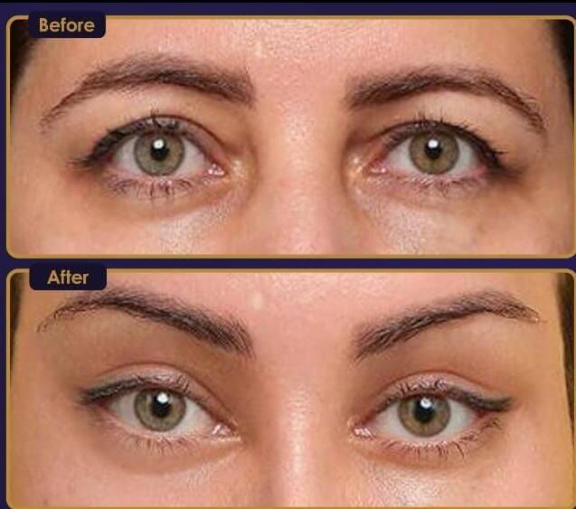 fox eye surgery (before and after)