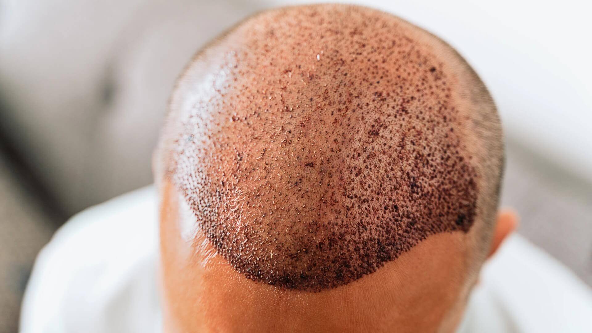 بعد عملية زراعة الشعر