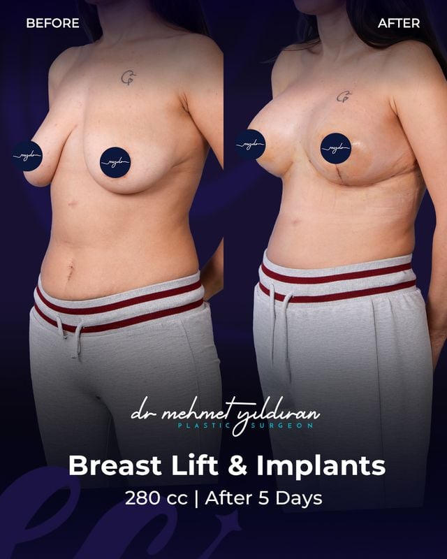 Breast Lifts and Implants (280cc) after 5 days
