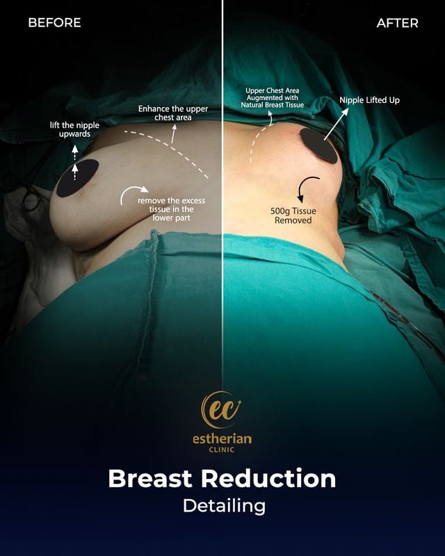 Breast reduction detailing and nipple lifting (before and after by the Estherian Clinic)
