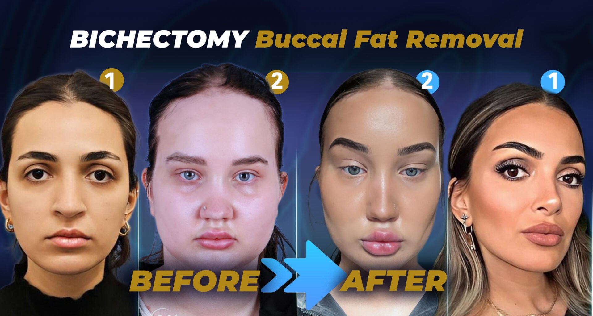 Estherian Clinic tarafından yapılan yanak yağı aldırma ameliyatı öncesi ve sonrası