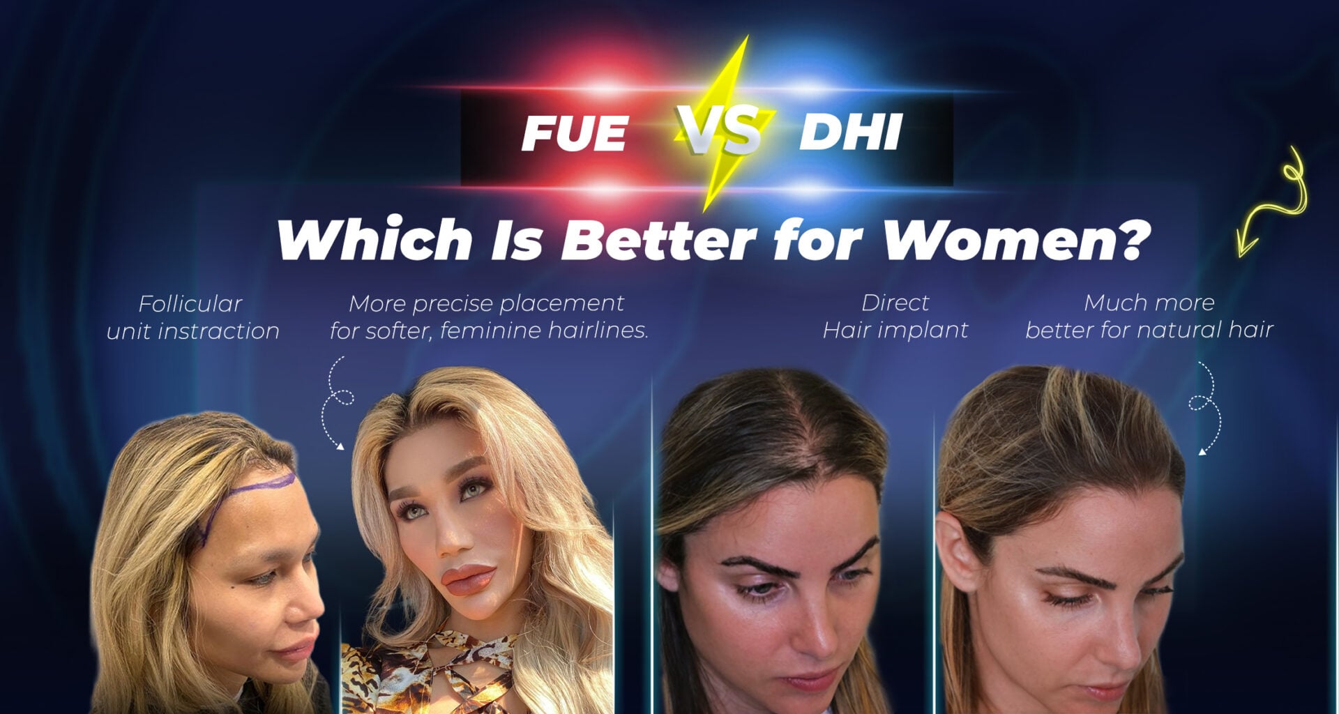 Greffe de cheveux FUE vs DHI pour femmes