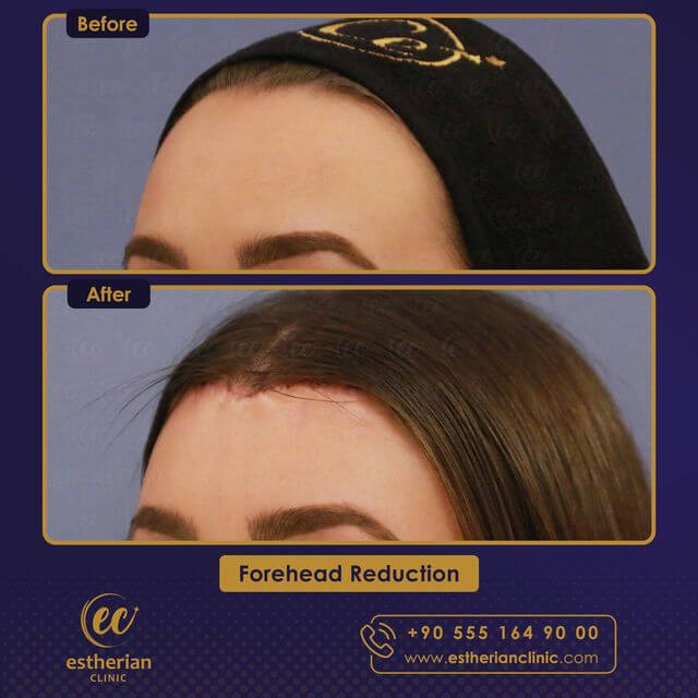 Forehead reduction surgery (before and after) results by the estherian clinic