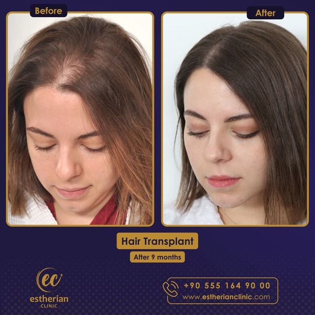 Hair Transplant results after 9 months