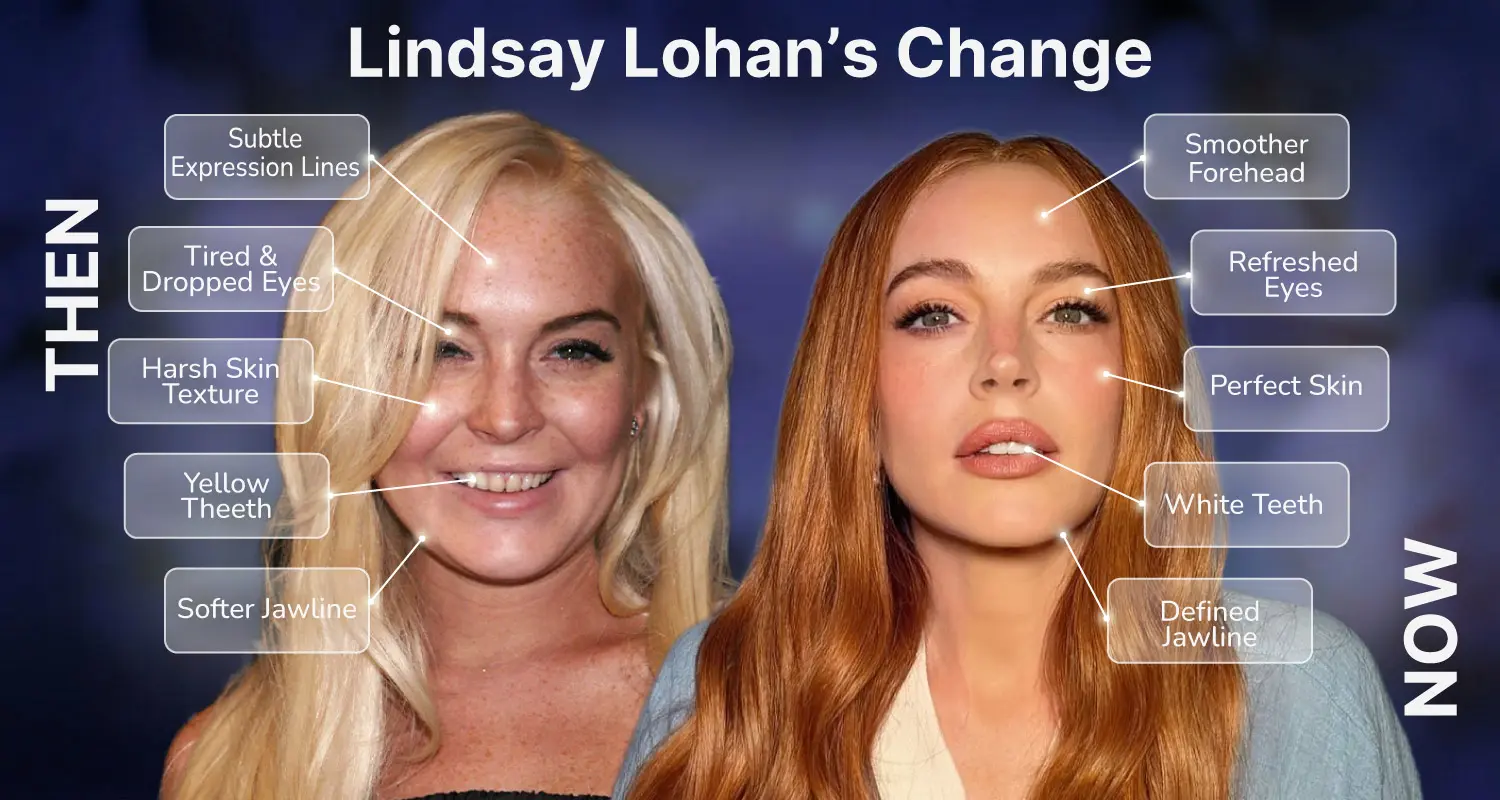 Facelift in Turkey-Lindsay-Lohan-Before-After