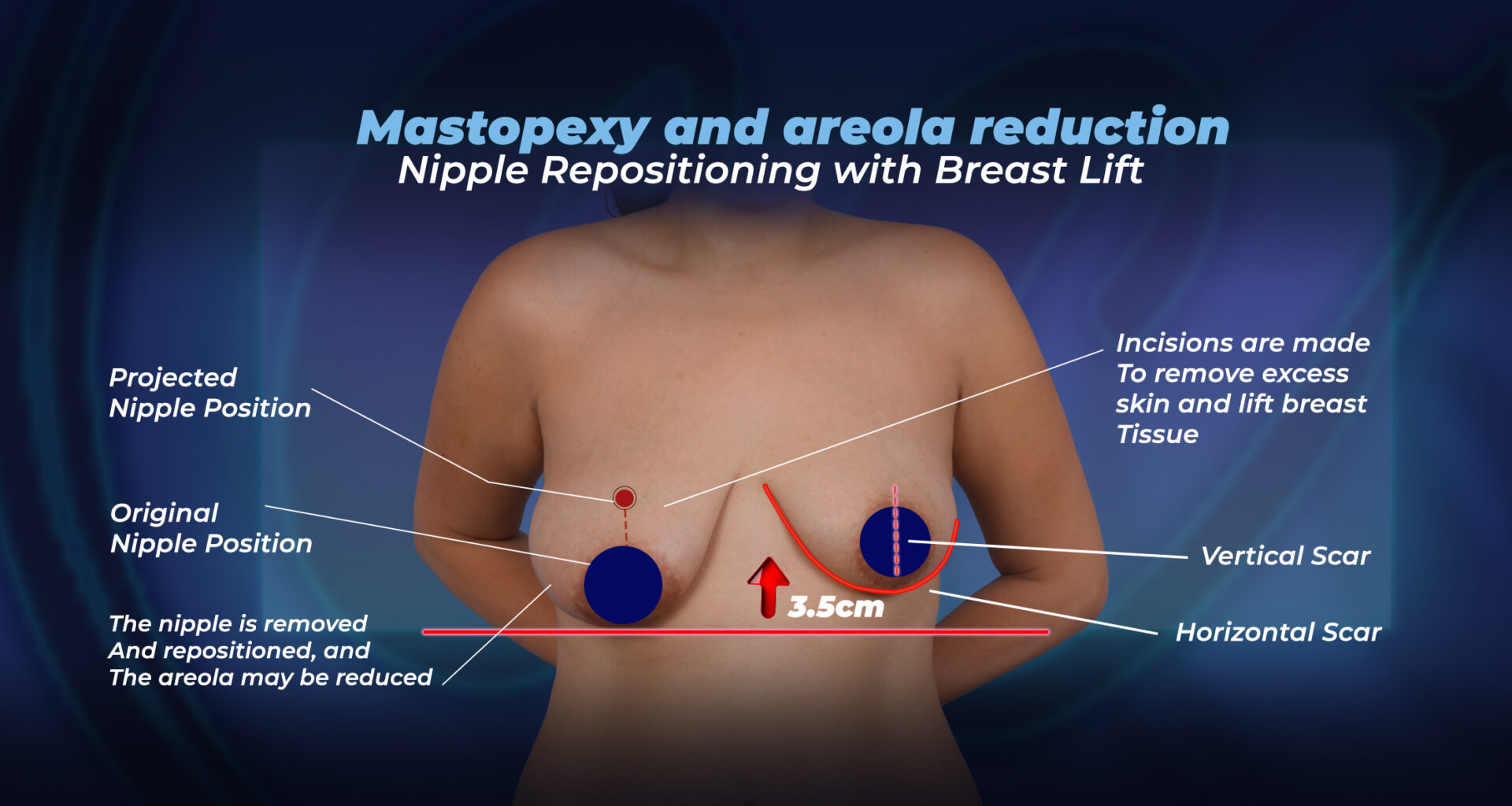 Mastopexie et réduction aréolaire
