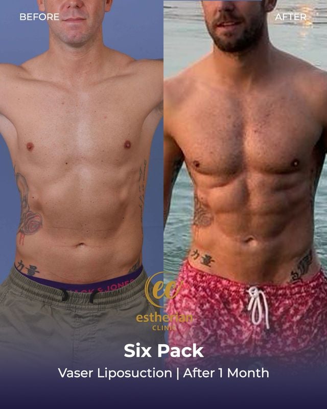 Sixpack-Behandlung (Vaser-Liposuktion) vorher und nachher