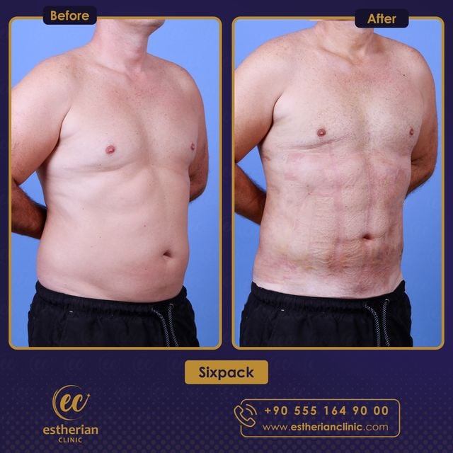 Sixpack-OP: Vorher und nachher (Ergebnisse der Estherian Clinic)