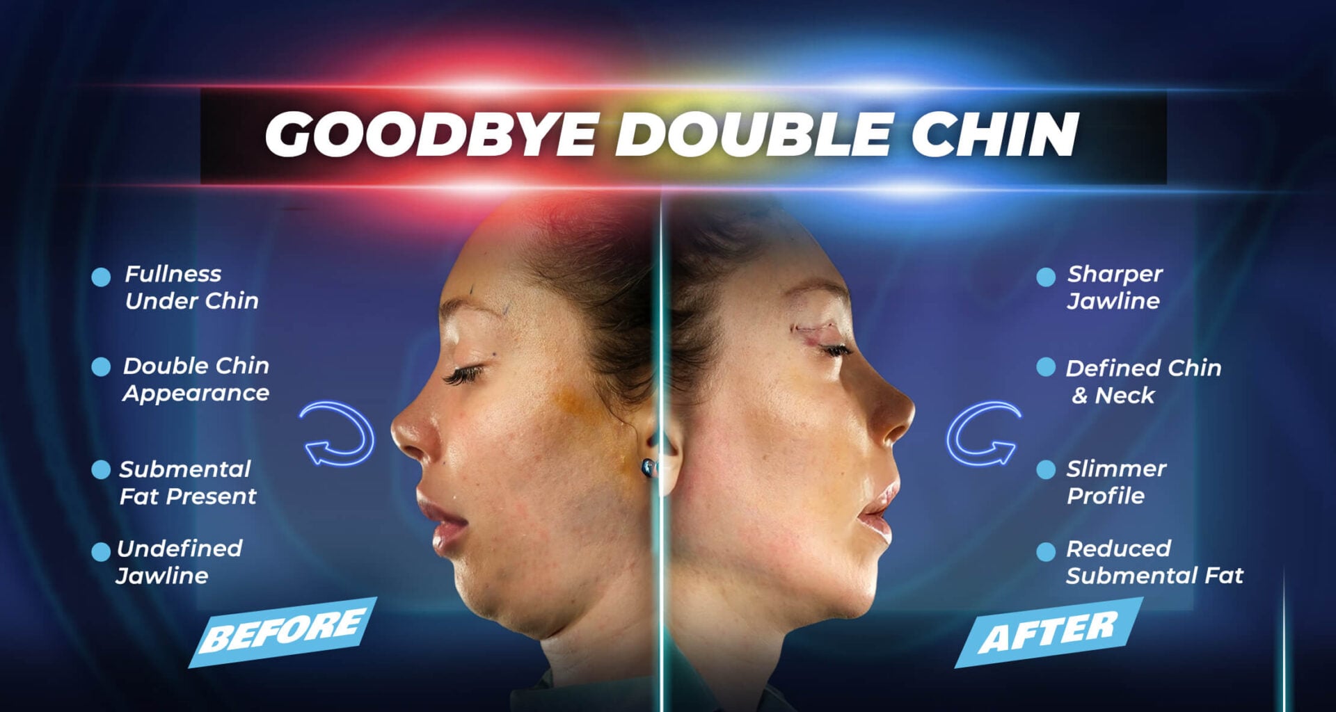 Estherian Kliniği tarafından yapılan çene liposuction sonrası iyileşme süreci (öncesi ve sonrası).