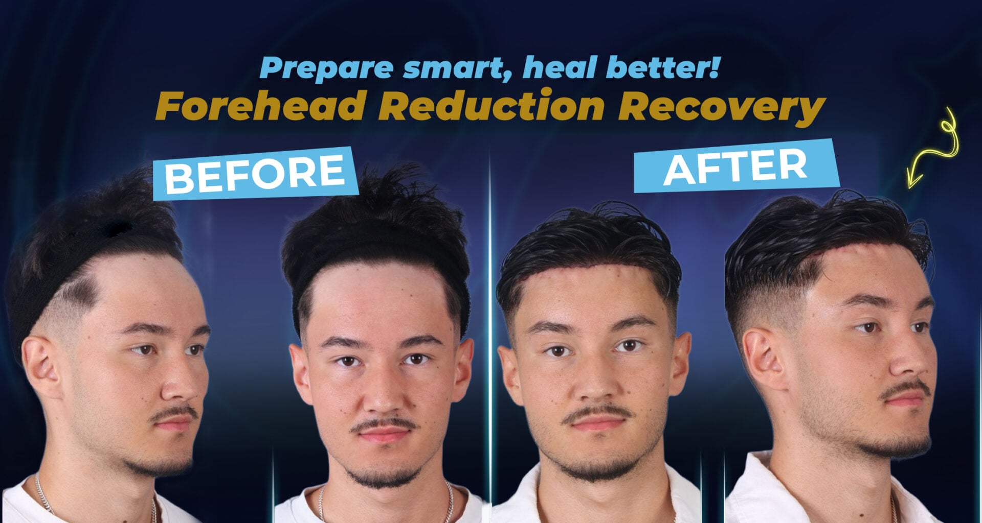 Photo avant/après d'une chirurgie de réduction du front par la clinique Estherian