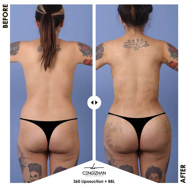 نتائج عملية شفط الدهون 360 درجة وتكبير المؤخرة البرازيلية (قبل وبعد) على يد الدكتور جنكيزهان من عيادة إستيريان