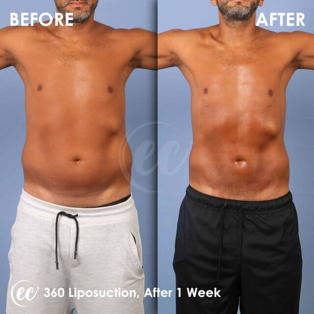 نتائج عملية شفط الدهون بزاوية 360 درجة (قبل وبعد) بعد أسبوع واحد في عيادة إستيريان