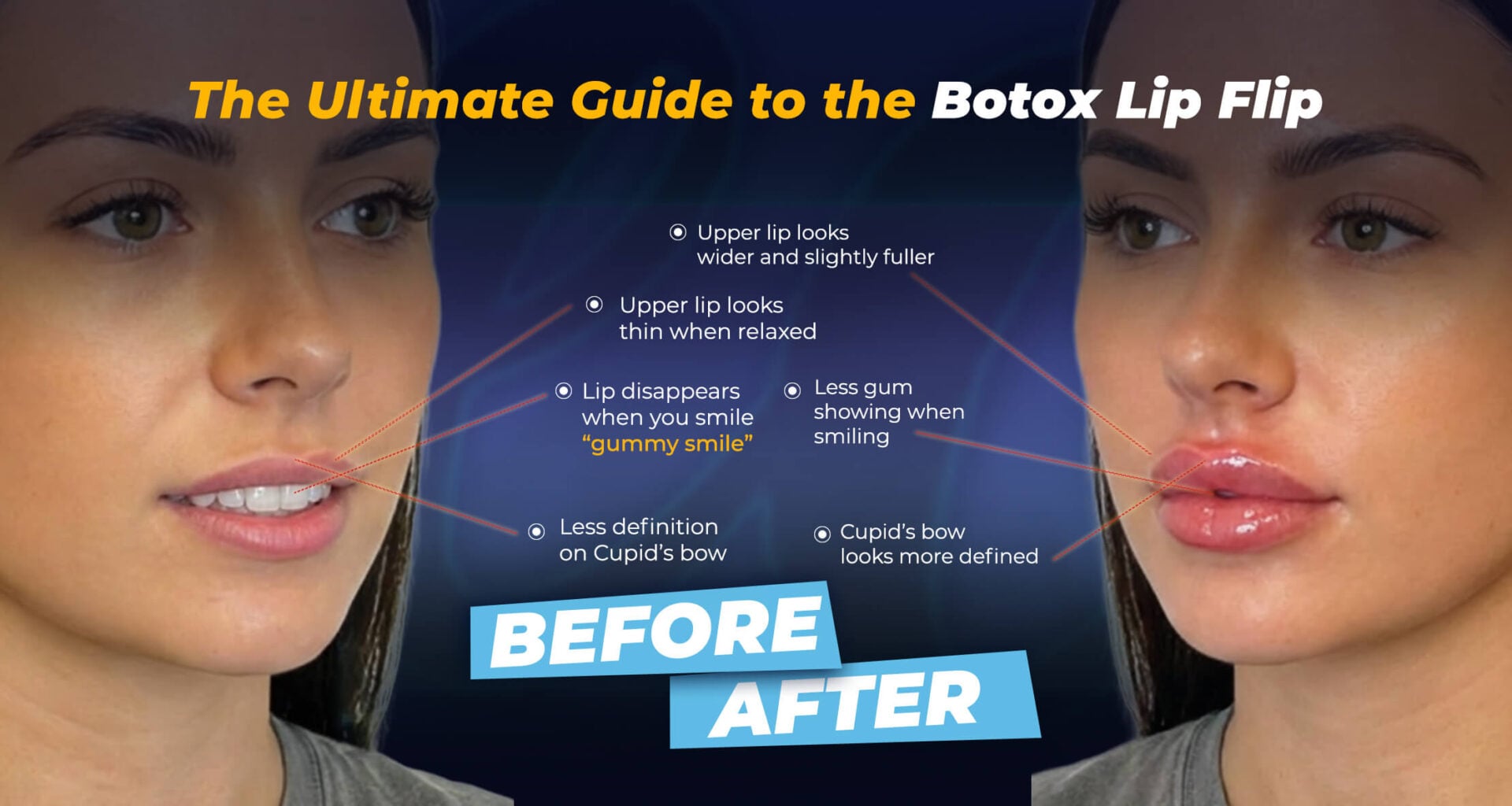 نتائج عملية تكبير الشفاه قبل وبعد العملية في عيادة إستيريان