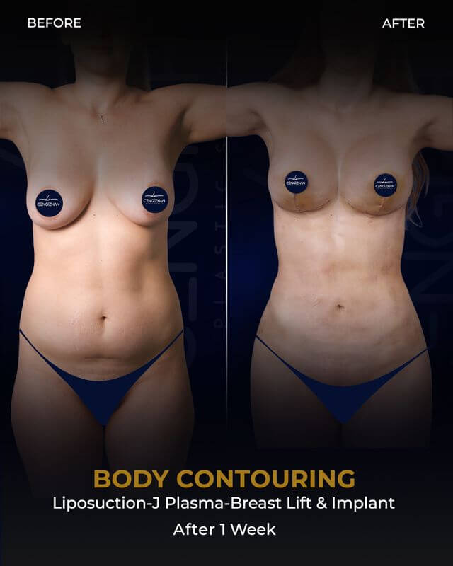 شفط الدهون، وبلازما جي، ورفع الثدي وزرع الثدي (النتائج بعد أسبوع واحد)