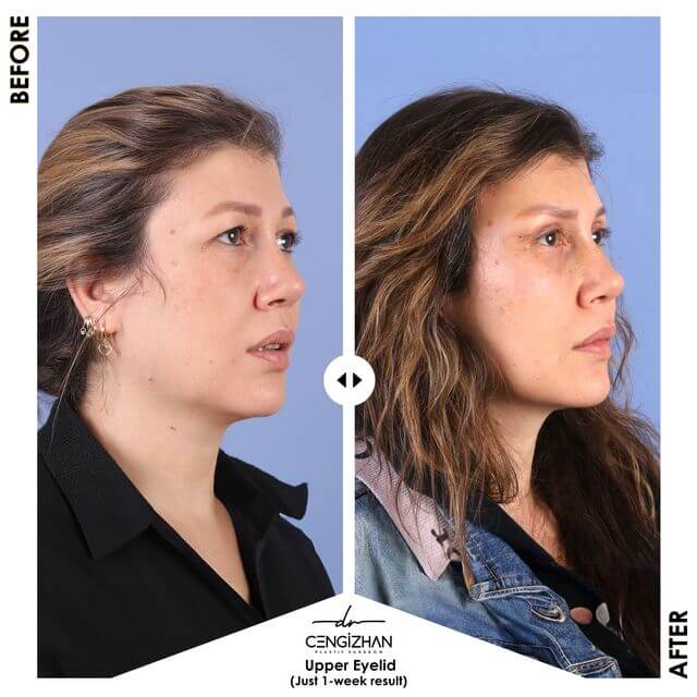 Estherian Kliniği'nden Dr. Cengizhan tarafından yapılan üst göz kapağı ameliyatı (öncesi ve sonrası) (1 hafta sonraki sonuçlar)