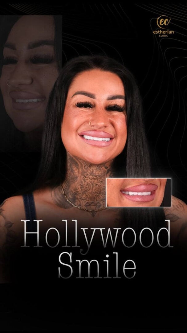 Hollywood Smile Results by the Estherian Clinic