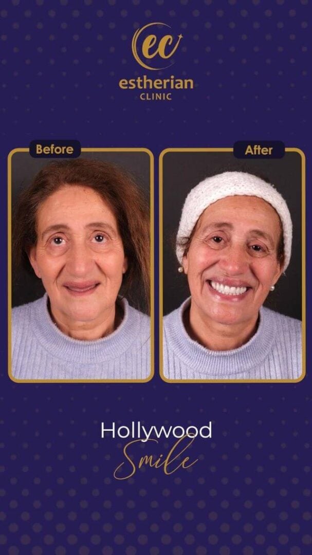 Hollywood Smile before and after results by the Estherian Clinic