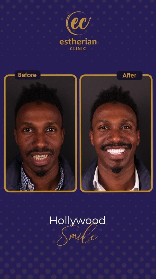 Estherian Kliniği'nden Hollywood Gülüşü (öncesi ve sonrası)