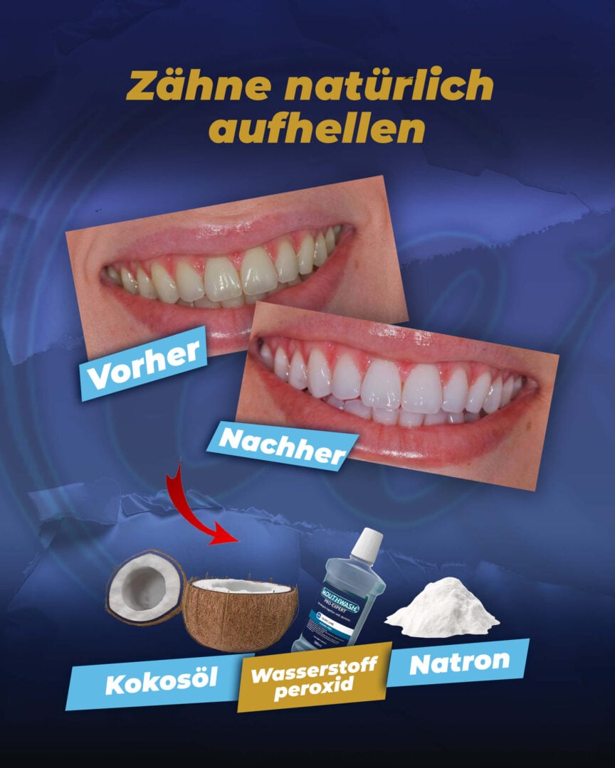 Wie man Zähne auf natürliche Weise aufhellt