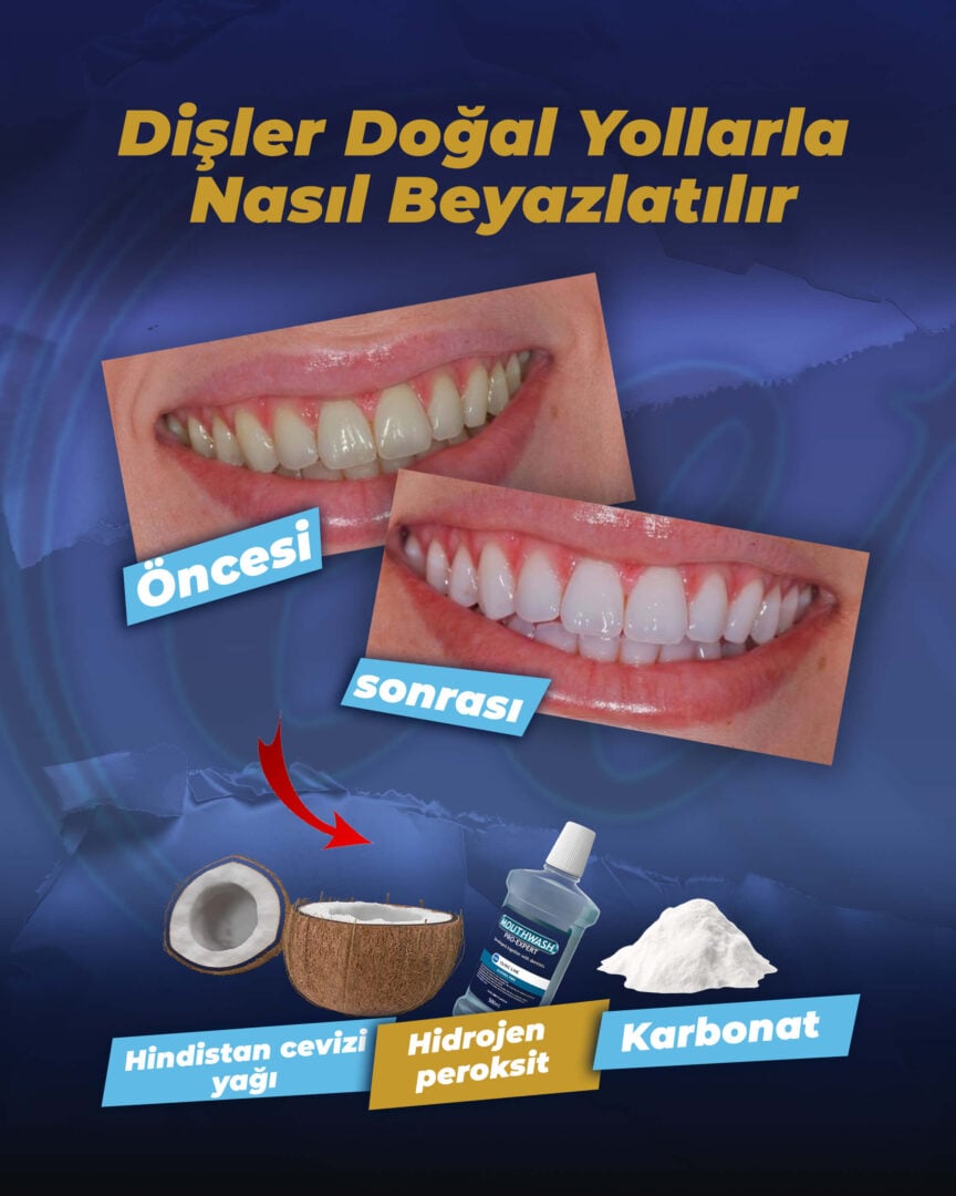 Dişleri Doğal Yöntemlerle Nasıl Beyazlatabilirsiniz?