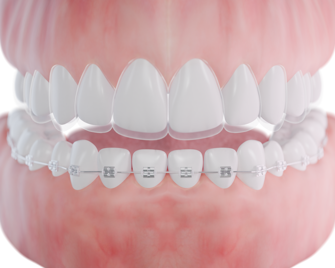 Invisaign-vs-Braces