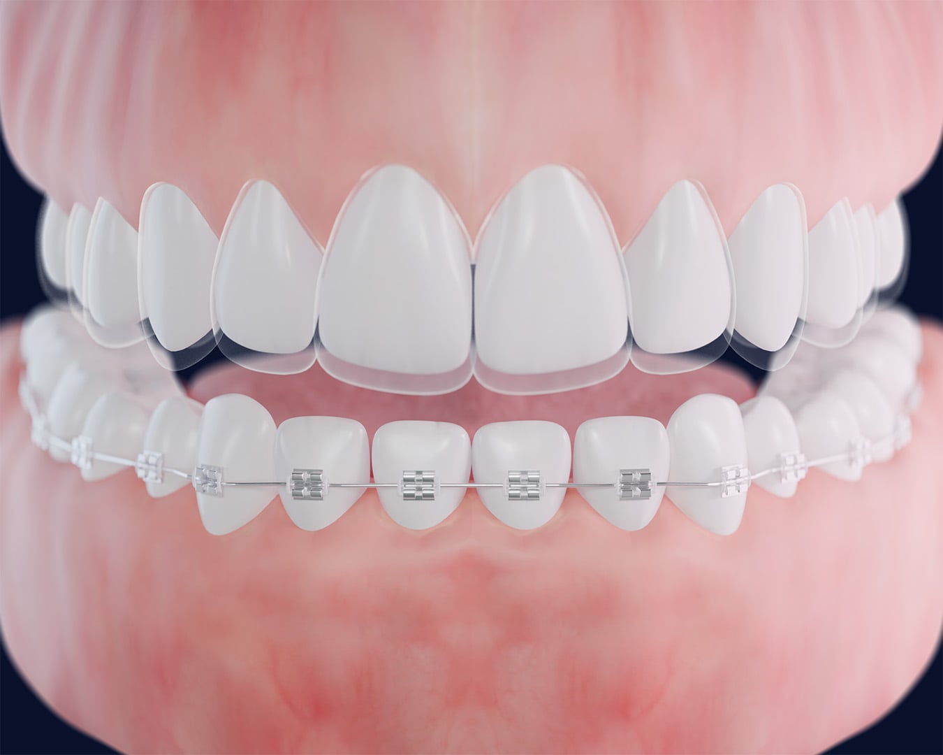 Invisaign-vs-Braces