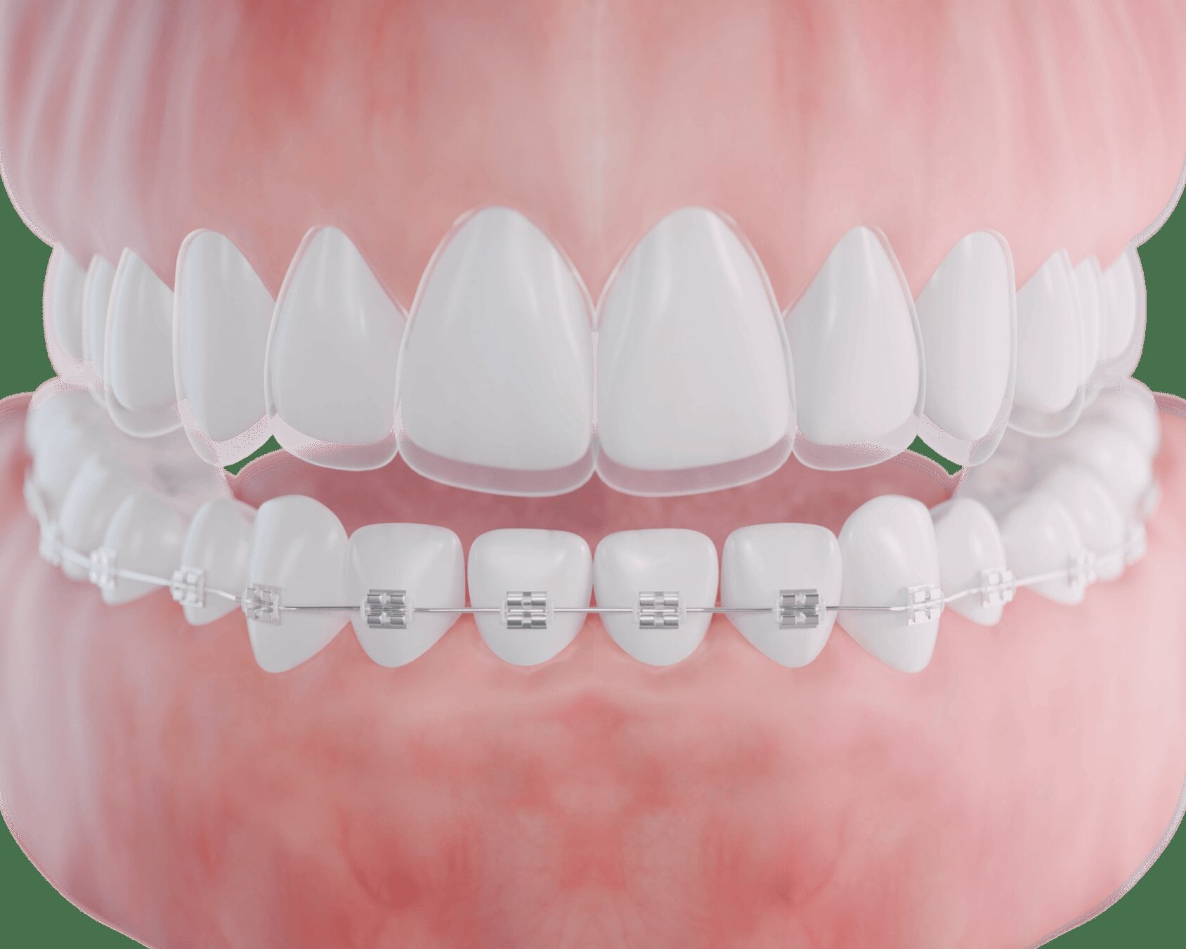 Invisaign contre appareils dentaires