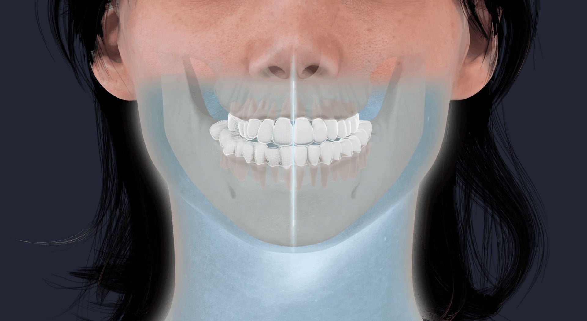 Invisalign-Before-After