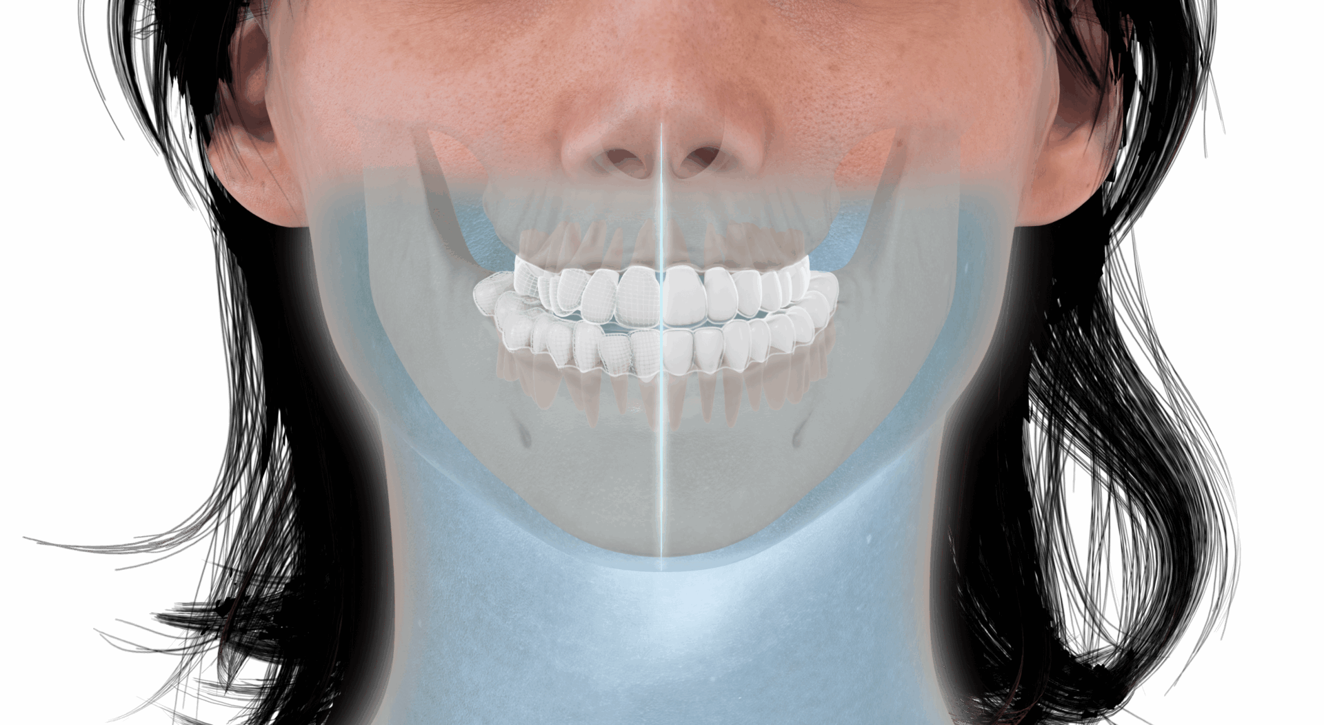 Invisalign-Before-After 