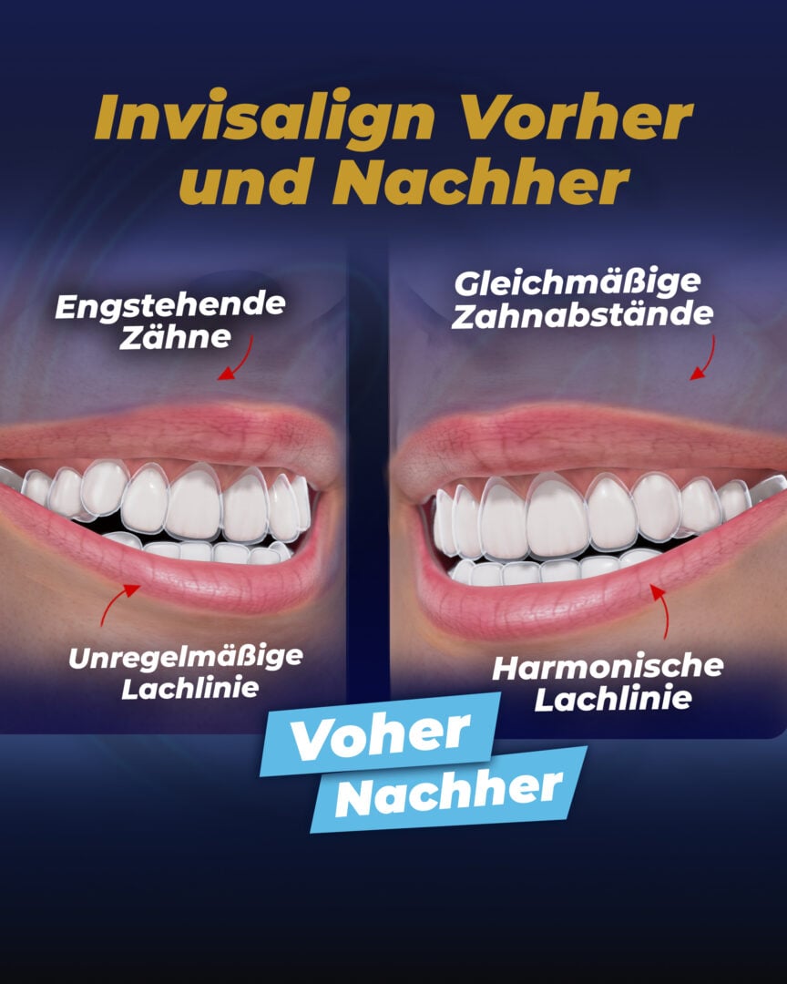 Invisalign – Vorher und Nachher