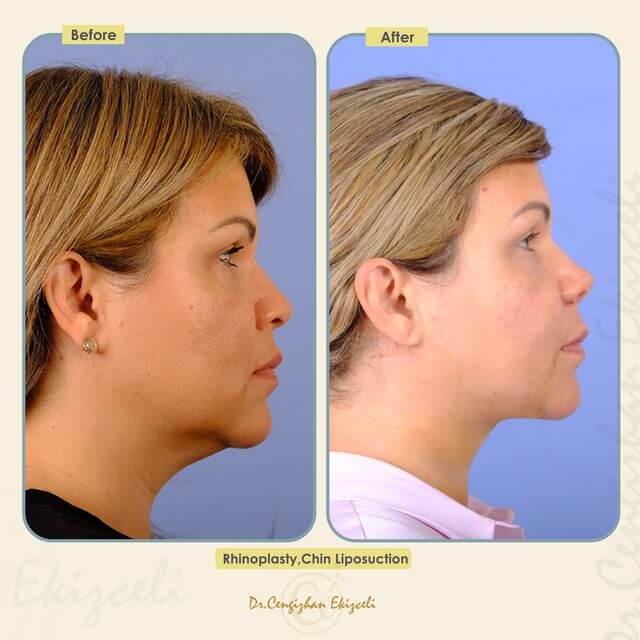 Rhinoplasty and chin liposuction before and after (results)
